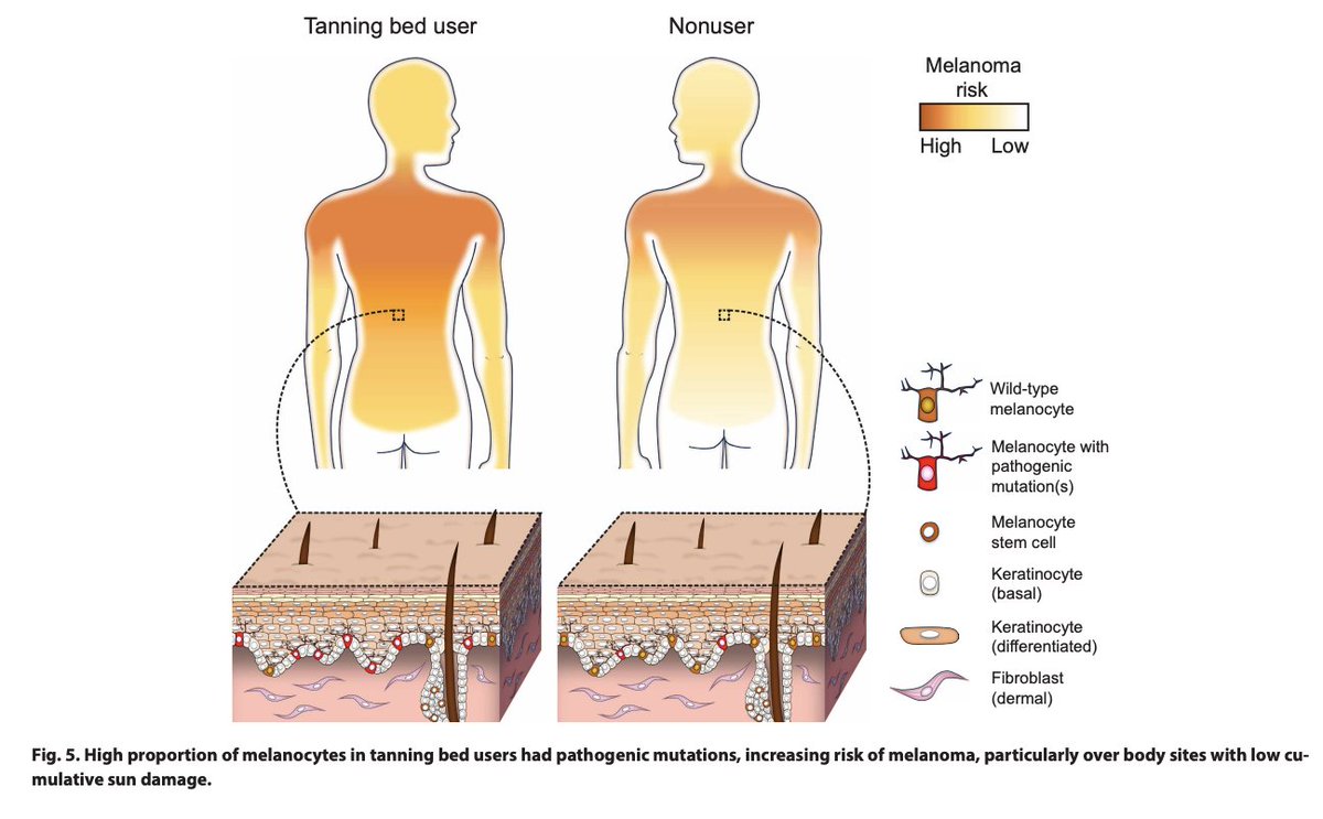 Solárka nejsou "zdravější formou" opalování. Právě naopak.

Jejich použití je asociováno s téměř o 300 % vyšším rizikem rakoviny kůže.

Lidé s více než 200 návštěvami solárií za život mají zvýšené riziko rakoviny více než 6x!

Zdroj: GERAMI, Pedram, et al. 2025