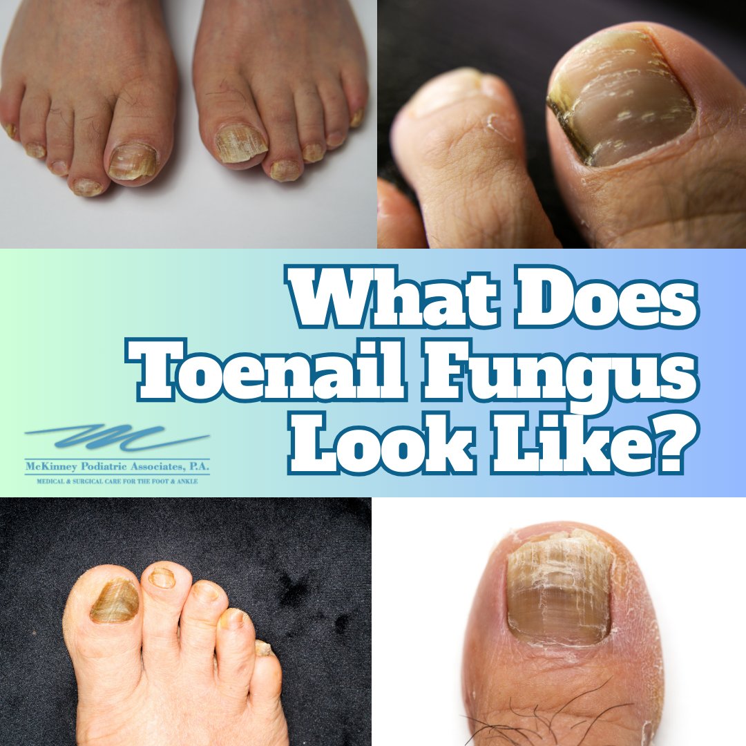 Toenail fungus is caused by fungal organisms that thrive in warm, damp environments (shoes, locker rooms, public showers). It may be yellow, white, or brown, with nails becoming thick, brittle, crumbly, or distorted. Some notice an unpleasant odor or debris under the nail.