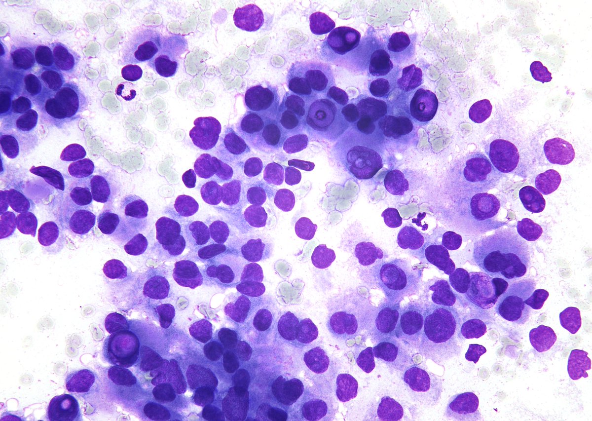 sza_jhcyto's tweet photo. I very often tell people that intranuclear inclusions in a "Medullary Thyroid Carcinoma" (when seen) will be much more impressive than papillary carcinoma or HTA - will be often multiple in the same nucleus (similar to the tall cell PTC) or double (inclusion within an inclusion). (FNA of a neck node)