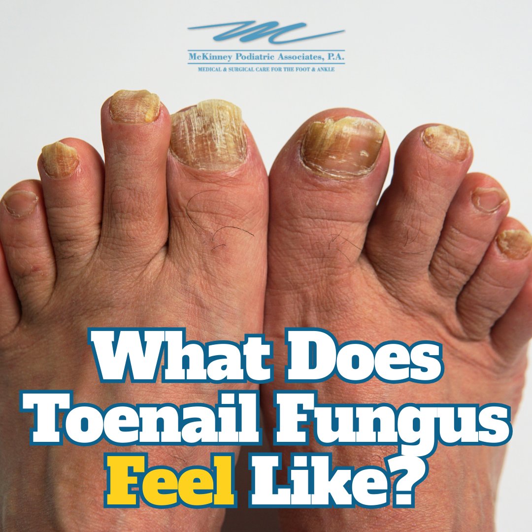 Toenail fungus may feel uncomfortable, sensitive, or painful, especially when pressure is applied from footwear, although it can also be painful in early stages.

mpa-web.com/blog/itemlist/…
