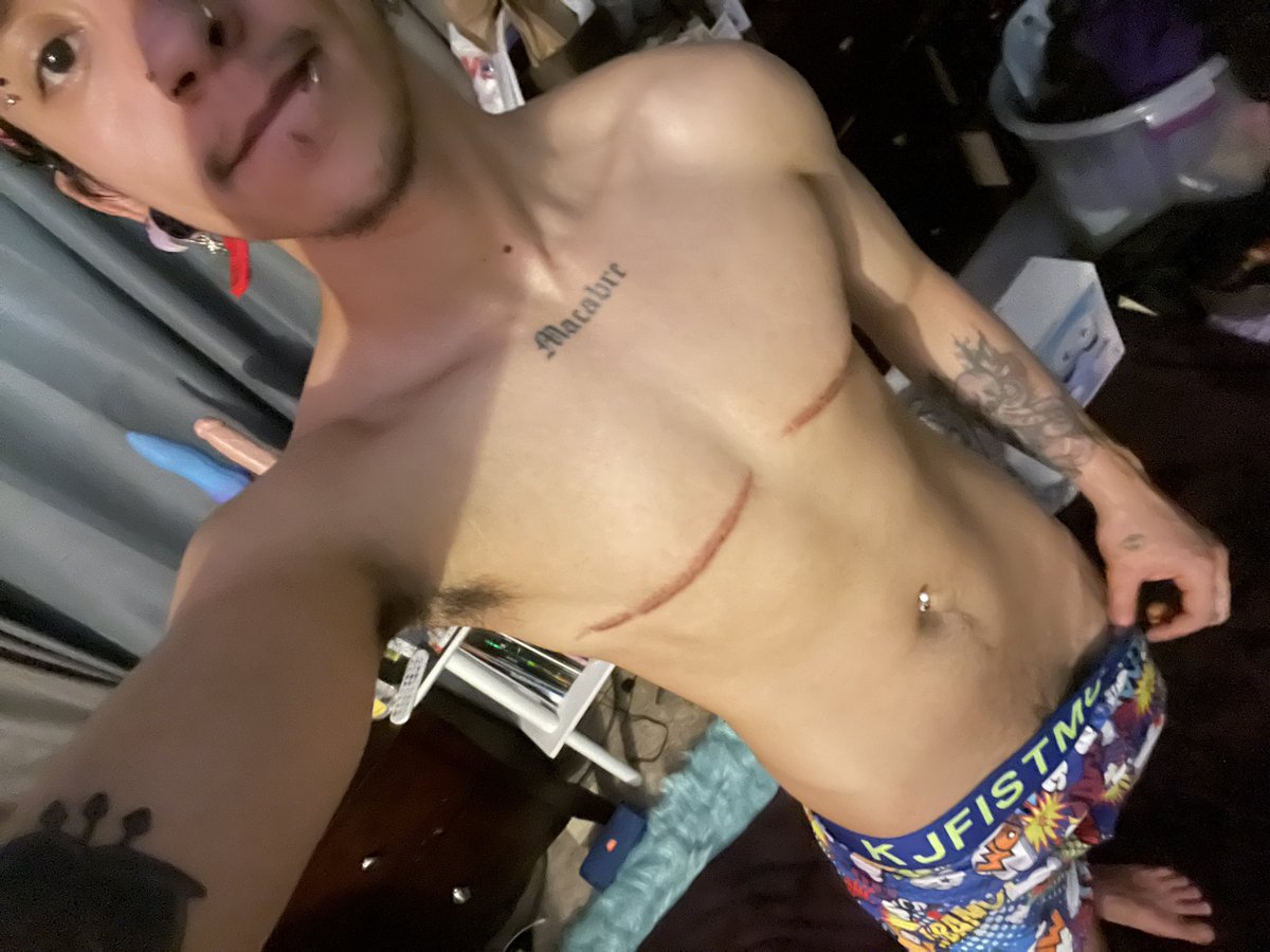 APrinceoflust's tweet photo. Ab vein and thigh vein coming in ๐ค๐ฅฐdoesnโt it look cute on me ๐๐
#ftm #nonips #trans https://t.co/sder1q0Pnm