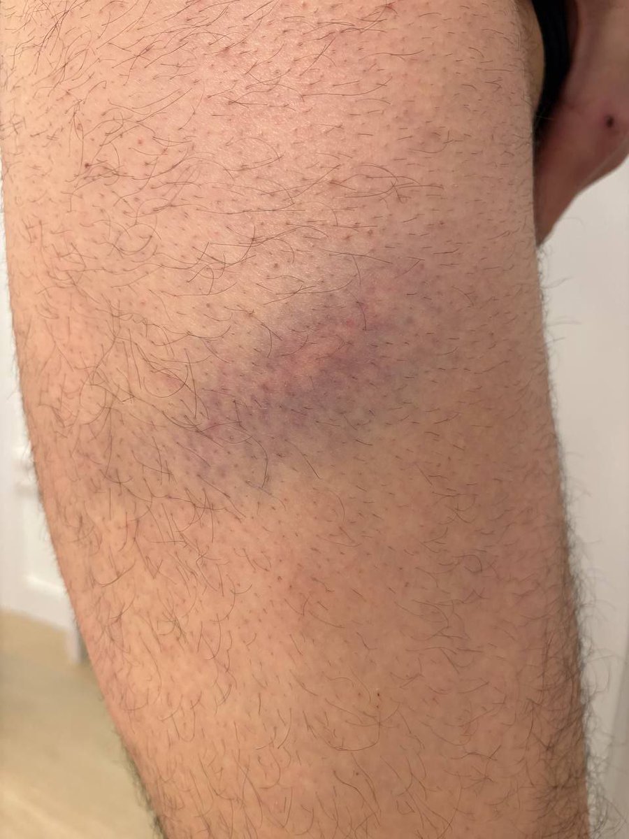 sadarbizirik's tweet photo. Seguimos recibiendo testimonios de las agresiones policiales a personas socias de Osasuna, dentro y fuera del Sadar, el pasado Sabado. 
sadarbizirik@gmail.com 
¡¡Basta de acoso al osasunismo popular!! 
6 Marzo, 19:00 horas, Plaza de los Fueros. https://t.co/0CDNqXDkqp