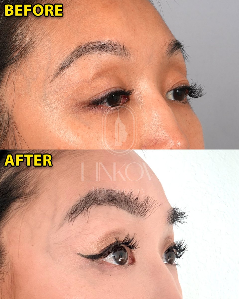 drgarynyc's tweet image. Eyebrow Hair Transplant 10 Months Post-Op!

#eyebrows #hair #hairtransplant #nyc #surgeon