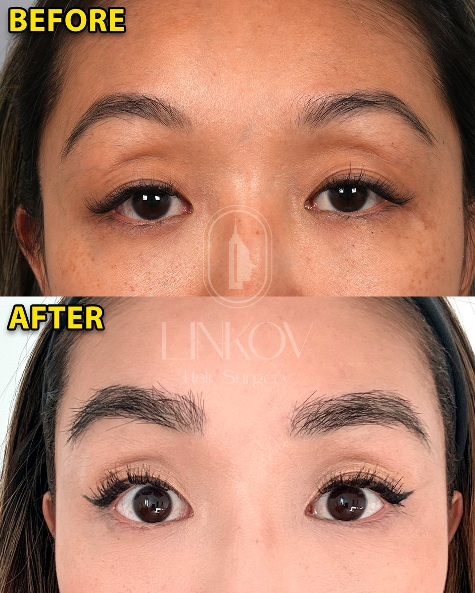 drgarynyc's tweet image. Eyebrow Hair Transplant 10 Months Post-Op!

#eyebrows #hair #hairtransplant #nyc #surgeon