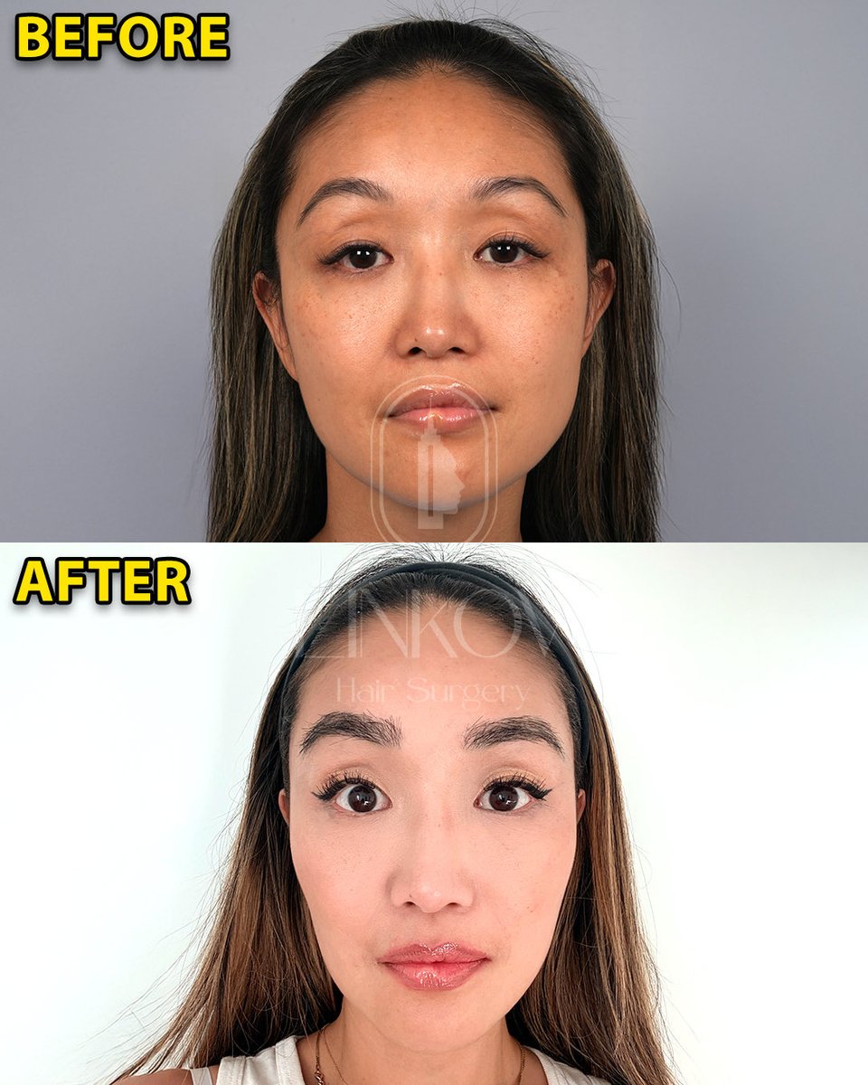 drgarynyc's tweet image. Eyebrow Hair Transplant 10 Months Post-Op!

#eyebrows #hair #hairtransplant #nyc #surgeon