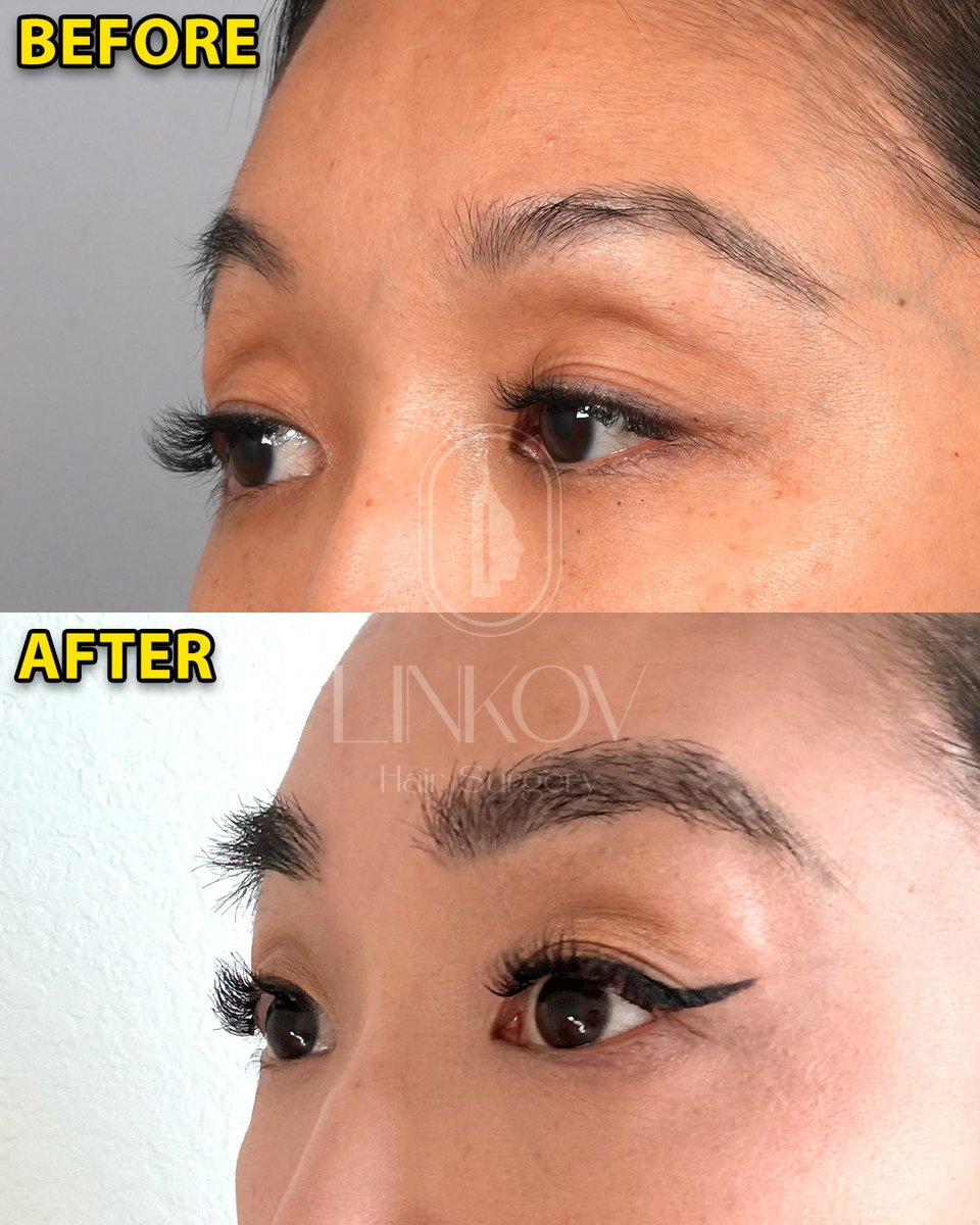 drgarynyc's tweet image. Eyebrow Hair Transplant 10 Months Post-Op!

#eyebrows #hair #hairtransplant #nyc #surgeon