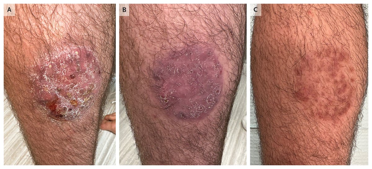 NEJM's tweet image. Images in Clinical Medicine: Majocchi’s Granuloma nej.md/4qCbUiO

#DermTwitter #IDTwitter