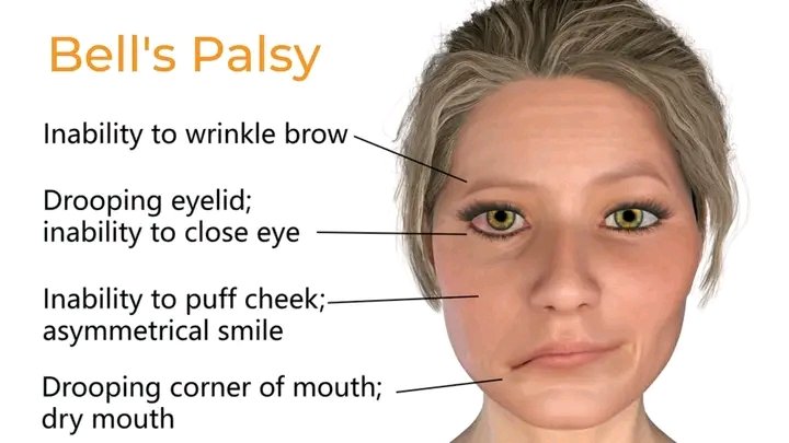 zakariyya_ms's tweet photo. Do you know that medication, surgery or eye protection help treat Bell's palsy but With #PHYSIOTHERAPY it offers faster recovery?

Have you or anyone around you experience Bell's palsy.

Usually started as weakness to one side of the face following seventh cranial nerve https://t.co/R1Wbptb70d