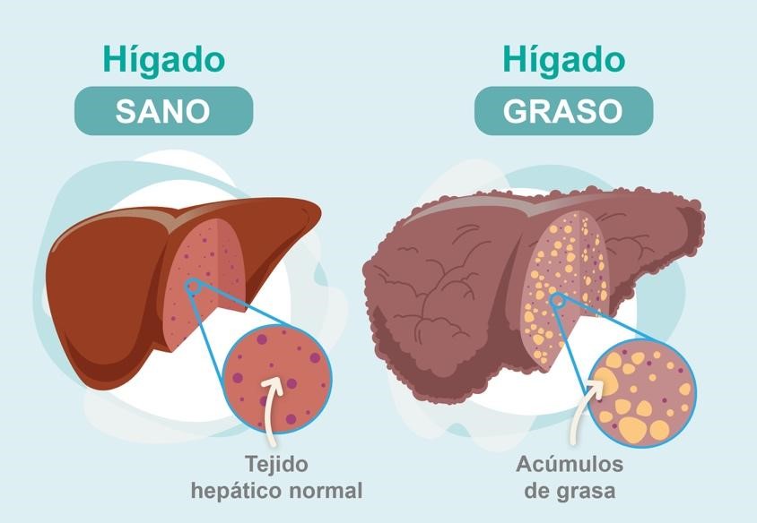 Se habla mucho del azúcar y muy poco de los aceites refinados de semillas.

Hidratos refinados + aceites de semillas + azúcar = obesidad/resistencia a la insulina/hígado graso/cáncer/problemas autoimunes/infartos.

En comentarios le dejo mi artículo
COMO SANAR EL HÍGADO GRASO