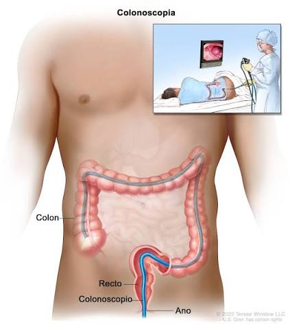 Colonoscopia    //////    Colonoscopia