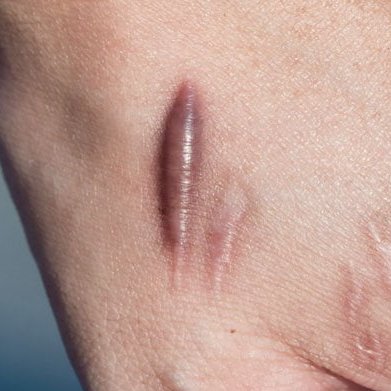 É DO BRASIL! Butantan desenvolveu uma pomada cicatrizante capaz de regenerar a pele e curar feridas sem formar queloides.