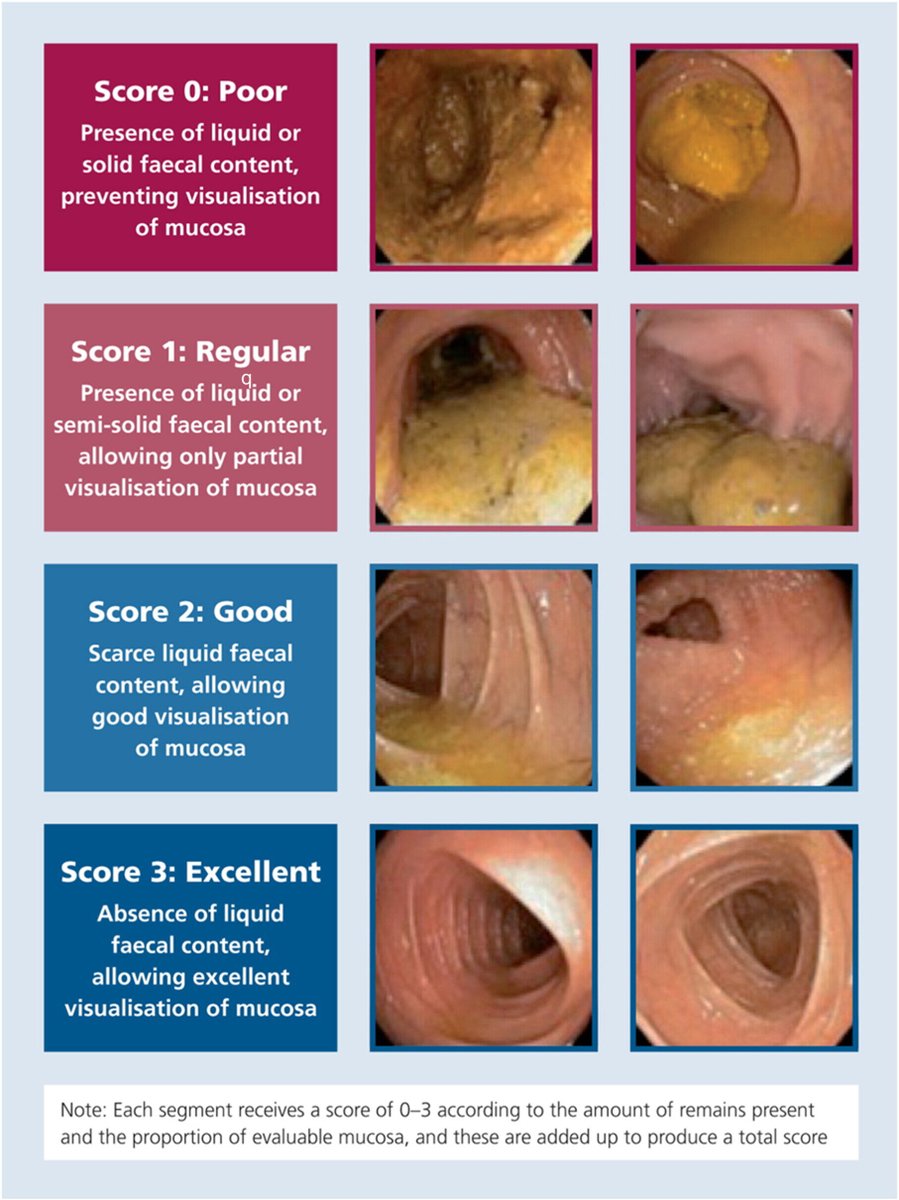 JPGNonline's tweet image. 🧻 Pediatric bowel prep remains inconsistent.

UK multicentre data show fewer centers meet bowel prep adequacy targets than ileal intubation standards—despite wide variation in regimens.

Standardization needed.

🔗 doi.org/10.1002/jpn3.7…

#pediatrics #pedsgi #Endoscopy