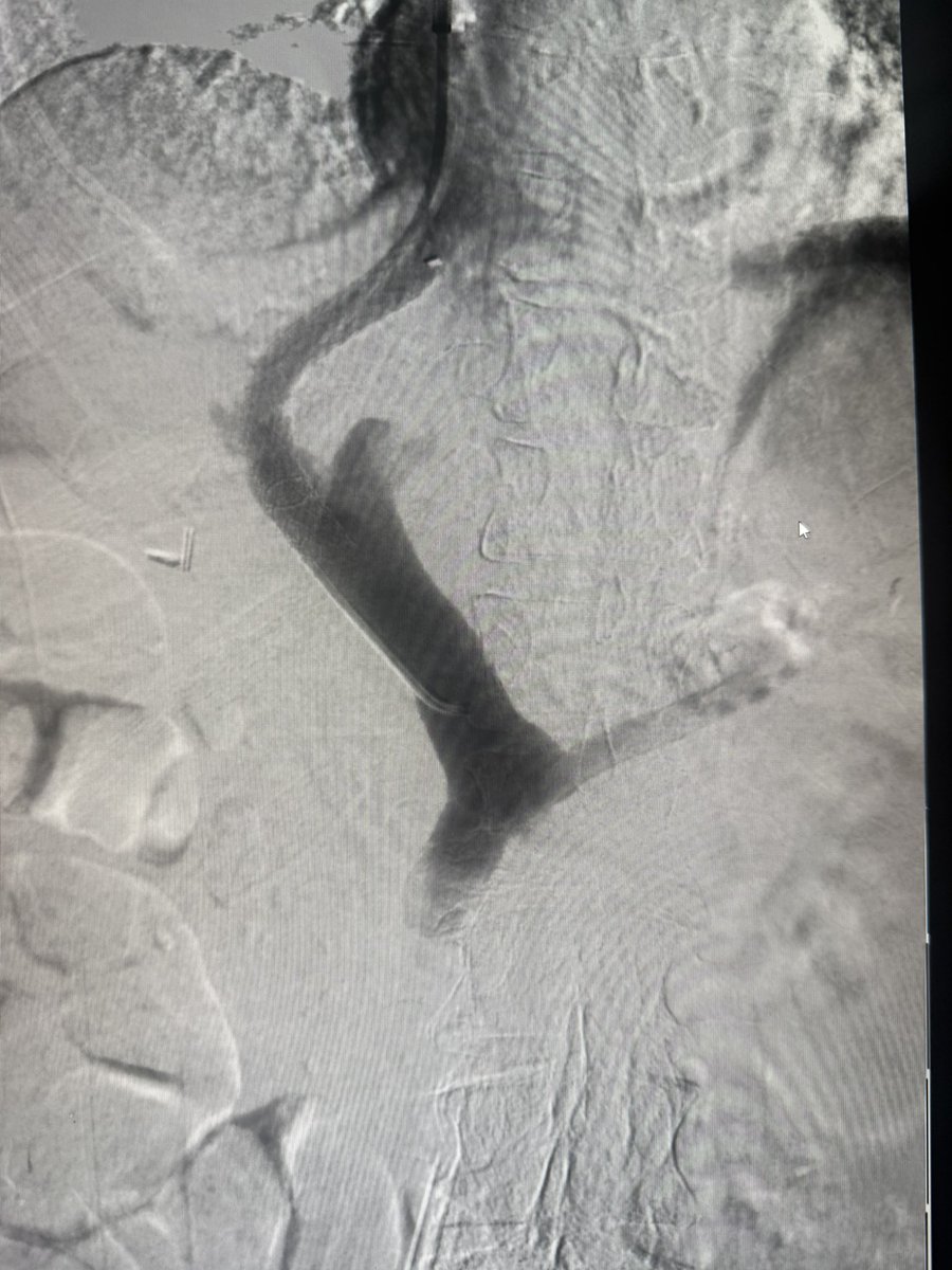 ChengaziMD's tweet image. #TIPSTuesday 

Two TIPS, one GA, one mod sed - both with embo, done by 11am

ICE and steerable needles have changed the game.