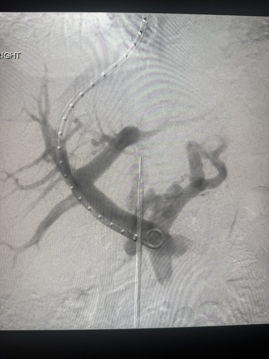 ChengaziMD's tweet image. #TIPSTuesday 

Two TIPS, one GA, one mod sed - both with embo, done by 11am

ICE and steerable needles have changed the game.