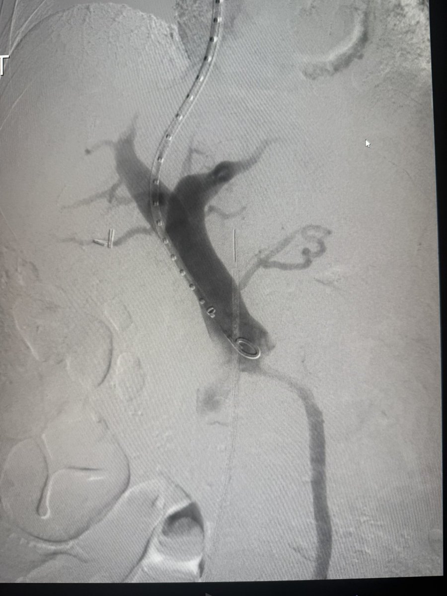 ChengaziMD's tweet image. #TIPSTuesday 

Two TIPS, one GA, one mod sed - both with embo, done by 11am

ICE and steerable needles have changed the game.