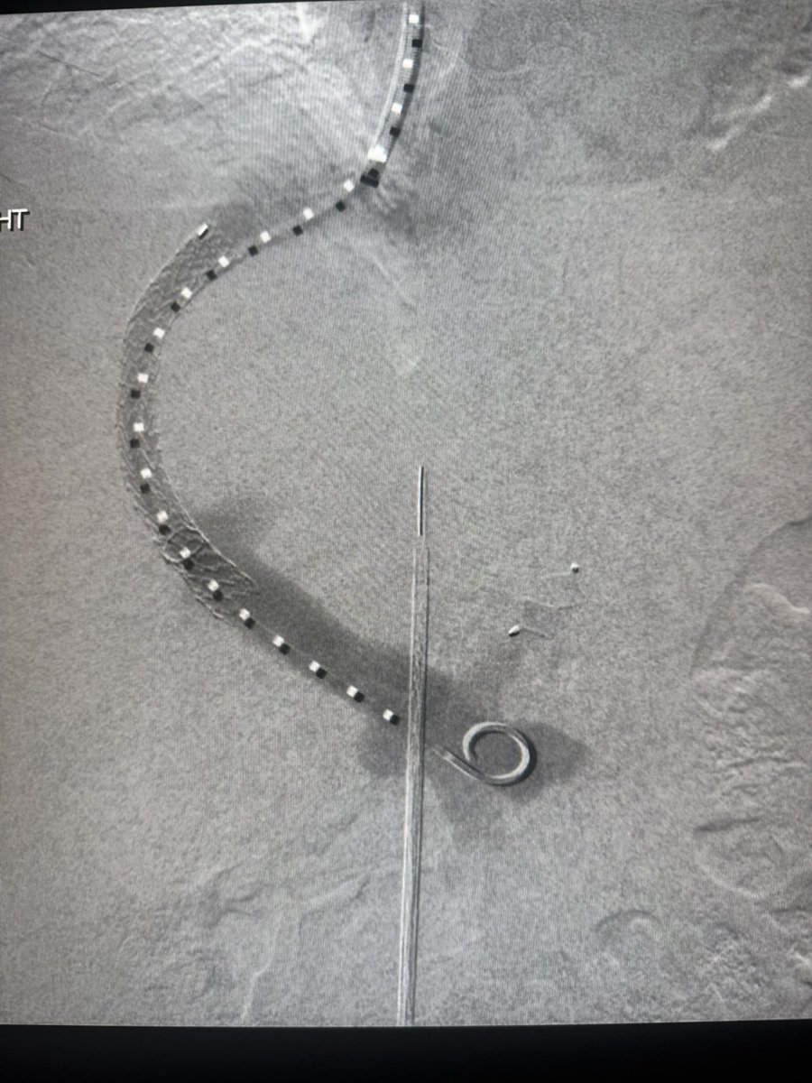 ChengaziMD's tweet image. #TIPSTuesday 

Two TIPS, one GA, one mod sed - both with embo, done by 11am

ICE and steerable needles have changed the game.