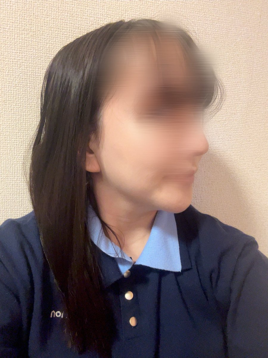 ft9575's tweet photo. 骨切りしてから3ヶ月経ちました。途中で不安な時もあったのですがいつも優しく対応してくださり本当に感謝しています😭
術前と比べると顔が小さくなったのがわかり嬉しいです。
大きな腫れは引いたのでまだこれから腫れが引くといいなと思っています。 https://t.co/qvNS819khz
