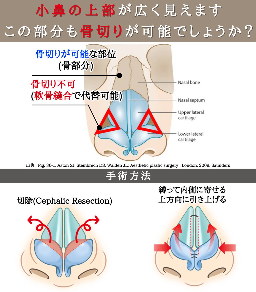 thebidanjp's tweet photo. 【小鼻の上部が広く見えます＝この部分も「骨切りが可能」でしょうか？】

鼻筋の骨切りの範囲を誤解されている方が多くいらっしゃいます。
鼻において骨切りが可能な部分は「骨がある領域」です。
(鼻の一番上、骨がある上部)

小鼻の上が膨らんで見えて、そこを狭めたい場合は
「軟骨縫合」で対応することが可能です。
多くの場合、軟骨が大きいことが原因で起こっています。

そのため、軟骨を部分的に切除しながら
上方向に縛って(長い鼻を短く形成)
内側に引き寄せることで、その部位がシャープに整います。
※ 加えて、脂肪の処理を行うことで、さらに仕上がりの完成度を高めることも可能です。

#鼻整形 #鼻手術 #鼻先軟骨結び