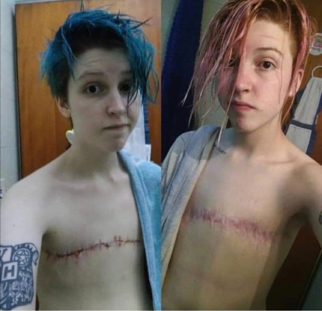 This is not healthcare. This is butchery. In 2022, I became the only US physician to file a Supreme court lawsuit exposing "gender affirming care" in minors. Not a single doctor stood beside me as I was slandered, harassed, threatened, and silenced. I'm still here. I'm not done.