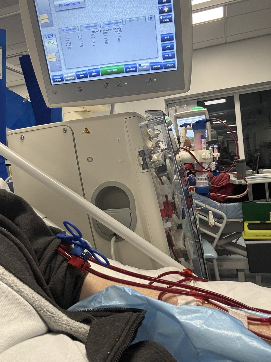 Patc1812's tweet photo. Mondays , Wednesdays and Fridays are dialysis days .4hour session each time . Blood taken out , cleaned , put back in 😁😁😁 I feel human for 24 hours . Follow the ups and downs of a dialysis patient waiting for a transplant, mixed in with the mistakes and triumphs of the past . https://t.co/XYY4pl7NcP