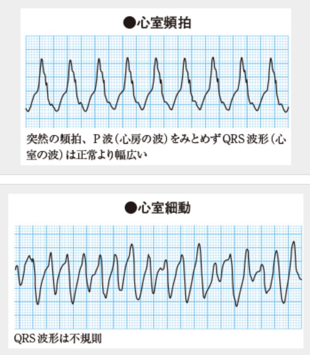 【国試対策】

本日も心臓よ💕
心臓はかなりあついからしっかりやっておくことが大切だわ💕

心房細動と心室頻拍、心室細動の心電図の区別は一目で分かるように何回も見ておくのがオススメよ💕