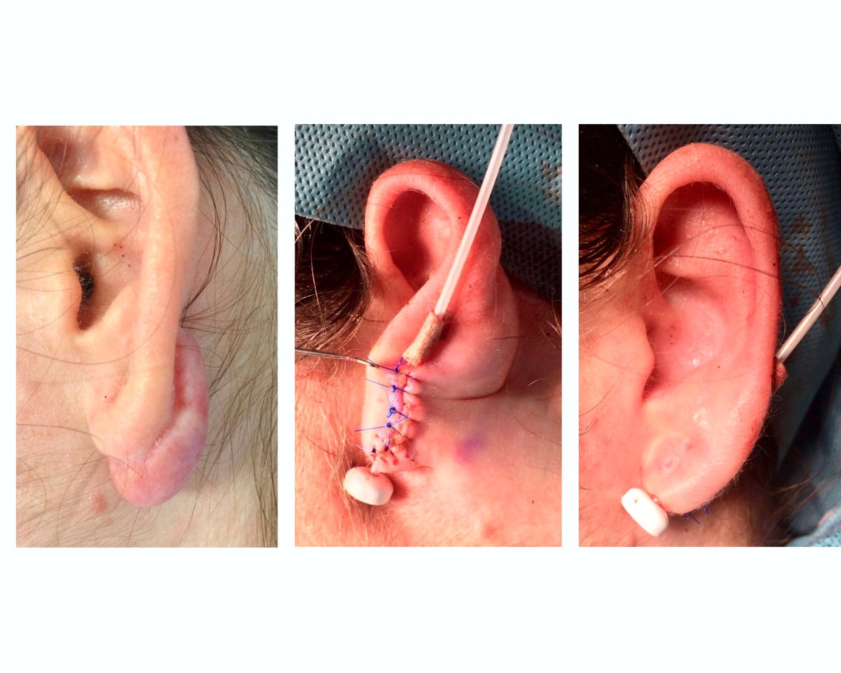 oncoradio_ryc's tweet image. 🚀 ¡Cerramos la semana con un caso clínico!

Ayer realizamos el tratamiento de un queloide en colaboración con C. Plástica

La braquiterapia intersticial permite reducir significativamente el riesgo de recidiva con mínimos efectos secundarios y excelentes resultados💪🏼

#Benigno