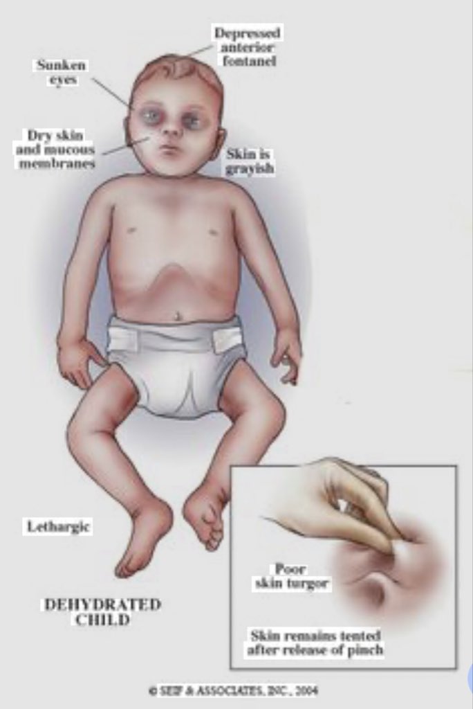 DeHealthguide's tweet image. Thread 🧵 you MUST read you can save a kid’s life.

SOME of you, despite being EDUCATED , remain ignorant about a misconception and a lie that lets children under 5 die avoidably.
Im here to fight that ignorance that kills those kids

Before you start reading, here are some key…