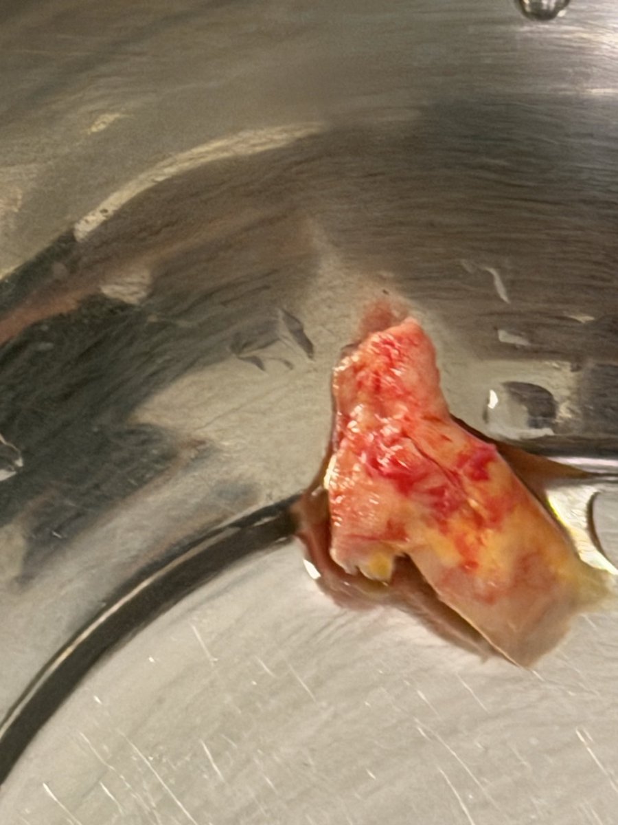 Günaydın dostlarım 
81 yaşında  teyzemiz şah damarında çıkardığımız plak %70-80darlık vardı   
Şimdi normal sorunsuz  
72. Şah damarı 👍
(karotisendarterektomi )ameliyatımız 
Şükür sorunsuz  komplikasyonsuz