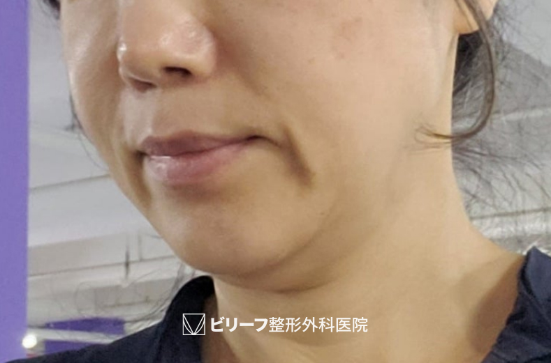 vlif_ps's tweet photo. 輪郭手術でも両顎手術でもありません。

どれだけ骨格がきれいでも、
たるんだ皮膚に隠れてしまえば意味がない。
隠れた輪郭を引き出す方法は、
フェイスリフトだけ。

#フェイスリフト
#たるみ改善
#輪郭ライン
#VLIF https://t.co/E8X88SPfdG