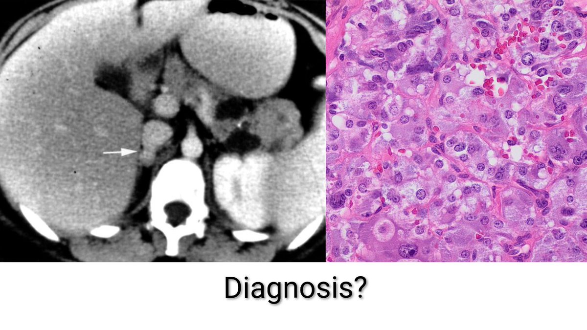 ⭕ A 35 year old female presents with recurrent episodes of headache, palpitations &amp; excessive sweating for the past 6 months. Her blood pressure during episodes is 200/110 mmHg. CT scan &amp; Histopathology images are shared below. What is the diagnosis?
 
A) Adrenocortical