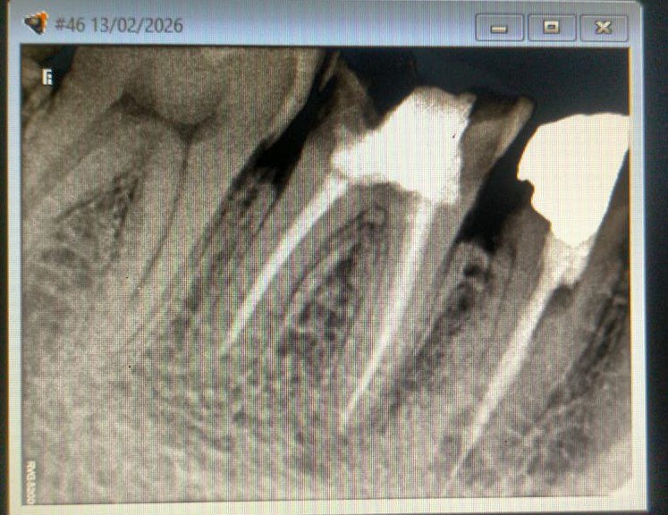 VitalTooth_'s tweet image. Microscopic endodontics is the way forward 👇🏻 
🙏🏻🙏🏻

Precision , Power to the treating #dental surgeons 🙏🏻