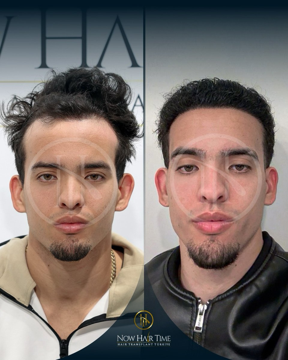 Before After Hair Transplant! #hairtransplant #hairtransplantation #hairtransformation #hairtransplantclinic #hairjourney #hairtreatments #hair #beforeafterhair #hairgoals #haircarespecialist #haircarespecialist #trapiantocapelli #trapiantodicapelli
