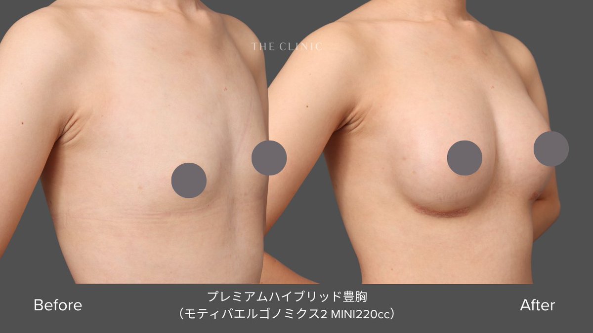 yuukitheclinic's tweet photo. 【自然も、変化も。妥協しないハイブリッド豊胸】
「自然さもほしい」「でも、1回でちゃんと変わりたい」
 この2つを両立したい方に選ばれているのが、ハイブリッド豊胸です！

💡こちらの症例の患者様はカウンセリングで
 ①できれば1回で施術を終えたい
 ②自然さは大事だけど、ある程度の変化もほしい
 ③異物への抵抗はない
 ④仕事で外出が多く、ダウンタイムも気になる
 ということから、ハイブリッド豊胸をご提案しました。

サイズ感は「バッグ感が出すぎるのは嫌」とのことで、シリコンはナチュラルな仕上がりになるMINIサイズを選択。
術後は、自然で身体になじむ仕上がりになっていますね。

ハイブリッド豊胸はこんな方におすすめ！
✅1回でしっかり変化を出したい
✅ 自然さ・柔らかさも妥協したくない
✅ 異物への抵抗はそこまで強くない
✅ 仕事や生活への影響をできるだけ抑えたい

豊胸術にはさまざまな選択肢があります。
仕上がり・メリット・デメリットを理解した上で、
自分に合う方法を選ぶことが大切です☺
＃豊胸　＃脂肪豊胸　＃ハイブリッド豊胸
＃豊胸の選び方