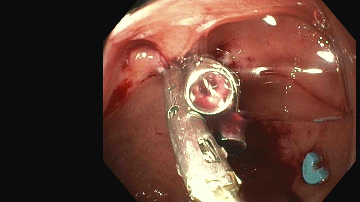Endoscopic mucosal resection (EMR) of a neuroendocrine tumor in the duodenal bulb. We used the <a href="/bsc_endoscopy/">Boston Scientific Endoscopy</a> Captivator kit to good effect. #gitwitter #surgery #oncology