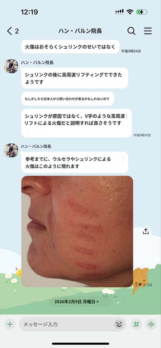 startplasty's tweet photo. 韓国でこのニュースを見た韓国の医師たちの意見は、シュリンクでは生じにくい火傷の痕跡であり、高周波を同時に施術した可能性が高い（Instagramで有名な皮膚科医とスタート整形外科の院長の意見も同様） シュリンクのような超音波レーザーによる火傷の跡は、添付された写真のように残る✨
参考までに、リフティングレーザー施術後また他の病院でまたリフティングレーザーを受けると、皮膚に刺激を与える可能性があるため、同じ部位へのレーザー施術は重複して近い将来に行わない方が安全ですので気を付けて下さい💕🤲