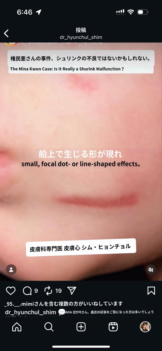 startplasty's tweet photo. 韓国でこのニュースを見た韓国の医師たちの意見は、シュリンクでは生じにくい火傷の痕跡であり、高周波を同時に施術した可能性が高い（Instagramで有名な皮膚科医とスタート整形外科の院長の意見も同様） シュリンクのような超音波レーザーによる火傷の跡は、添付された写真のように残る✨
参考までに、リフティングレーザー施術後また他の病院でまたリフティングレーザーを受けると、皮膚に刺激を与える可能性があるため、同じ部位へのレーザー施術は重複して近い将来に行わない方が安全ですので気を付けて下さい💕🤲