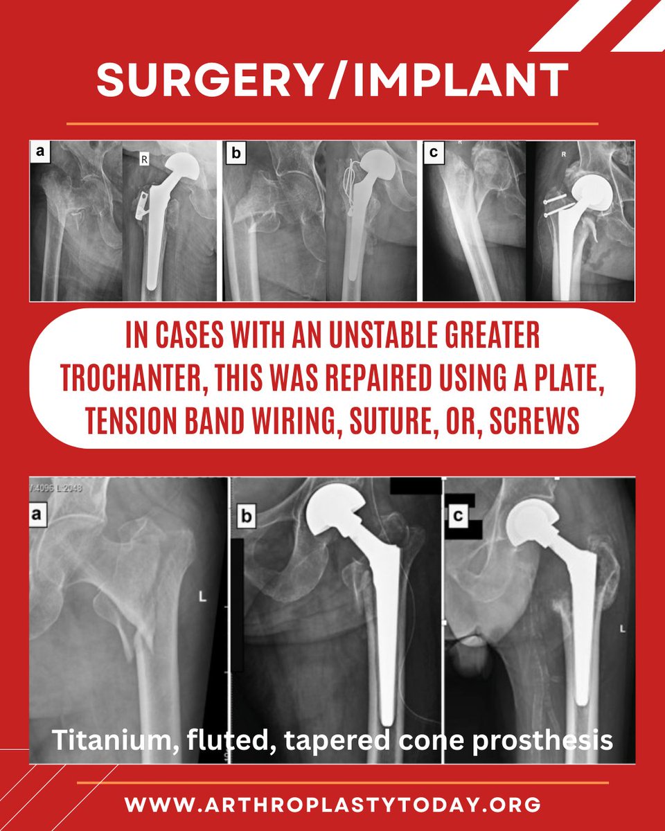ArthroToday's tweet photo. Fix or replace? 

Most intertrochanteric femur fractures are managed with open reduction and internal fixation.  However, in this study, authors report good outcomes utilizing an uncemented, tapered, fluted cone stem. 

Do you trust this technique?

https://t.co/MHHm1BA8Kp https://t.co/SE2UalskNz