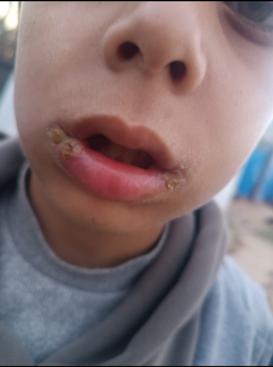 yousefQasem1998's tweet photo. He's dying 😭
 
My little brother is sick. His lips are severely cracked and extremely dry, with yellowish-white scales, and there's redness and irritation around his mouth. It looks painful and he needs treatment. 
 
If you see this reply with a dot.or🇵🇸

https://t.co/hR7oM0tumZ https://t.co/6cqCwcqzy1