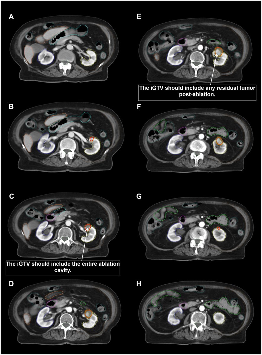 In this new #RedJournal article, IROCK Contouring Guidelines now available for Renal SABR!  tinyurl.com/rjadhar