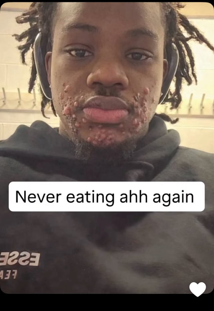 A Snapchat influencer laments bitterly after engaging in a certain sexual act leading to this tragedy. 
Does it have a cure?