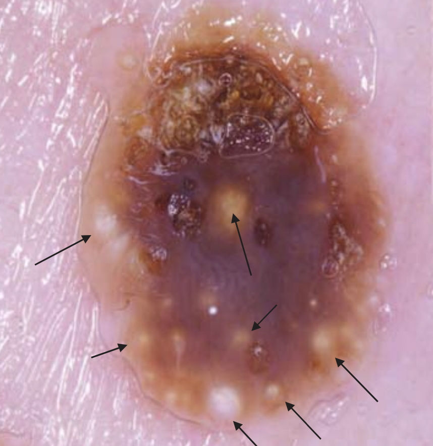DermMarianne's tweet photo. 1⃣ Dermoscopic structure a day
🟡 Milia-like cysts
Variously sized white or yellow structures
Seen in seborrheic keratosis but also in benign & malignant melanocytic lesions
#dailyscope https://t.co/uUvcCySETG