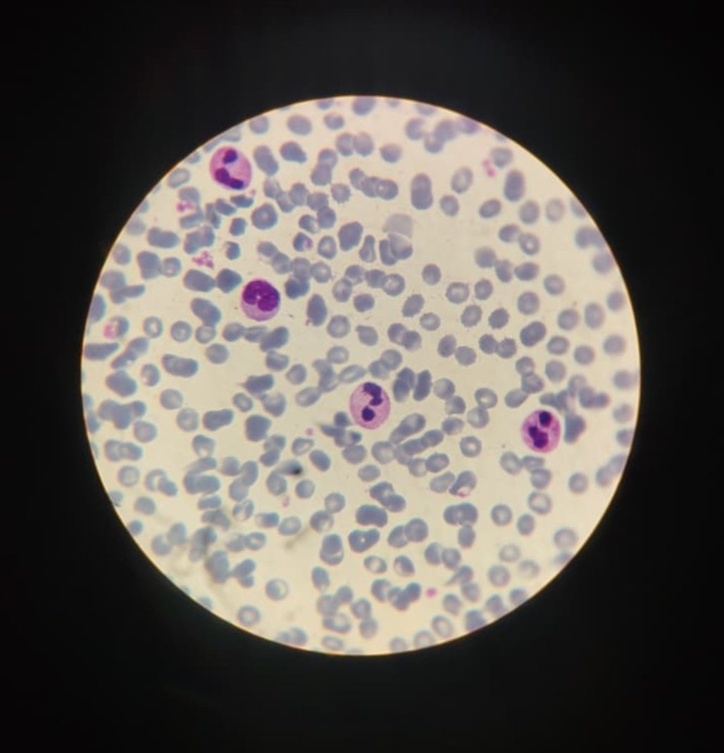 La imagen muestra leucocitos al microscopio, células clave del sistema inmunológico. Se distinguen por su núcleo y su función en la defensa del organismo.Son esenciales para combatir infecciones y mantener el equilibrio interno del cuerpo
#HistologíaHematologíaInmunología
#UCMLT