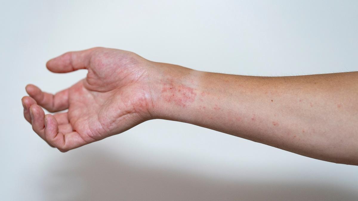 ❄️👶👧 El invierno tampoco es una buena época para los niños que sufren #DermatitisAtópica.

Las tareas divulgativas de la Sociedad Española de Inmunología Clínica, #Alergología y #Asma Pediátrica (SEICAP) incluyen una serie de recomendaciones para minimizar los efectos del frío