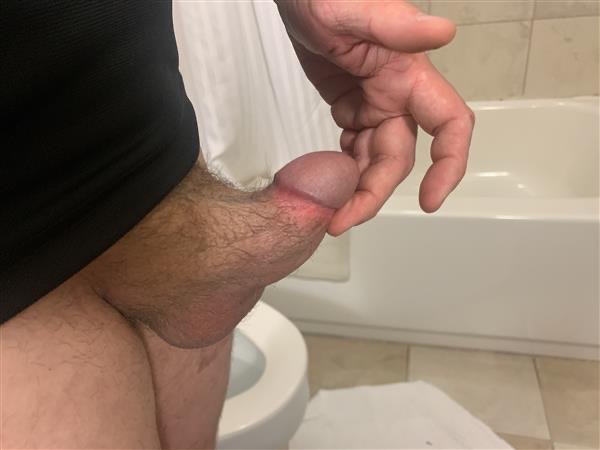 阴茎缩短术Penile skin castration tweet media