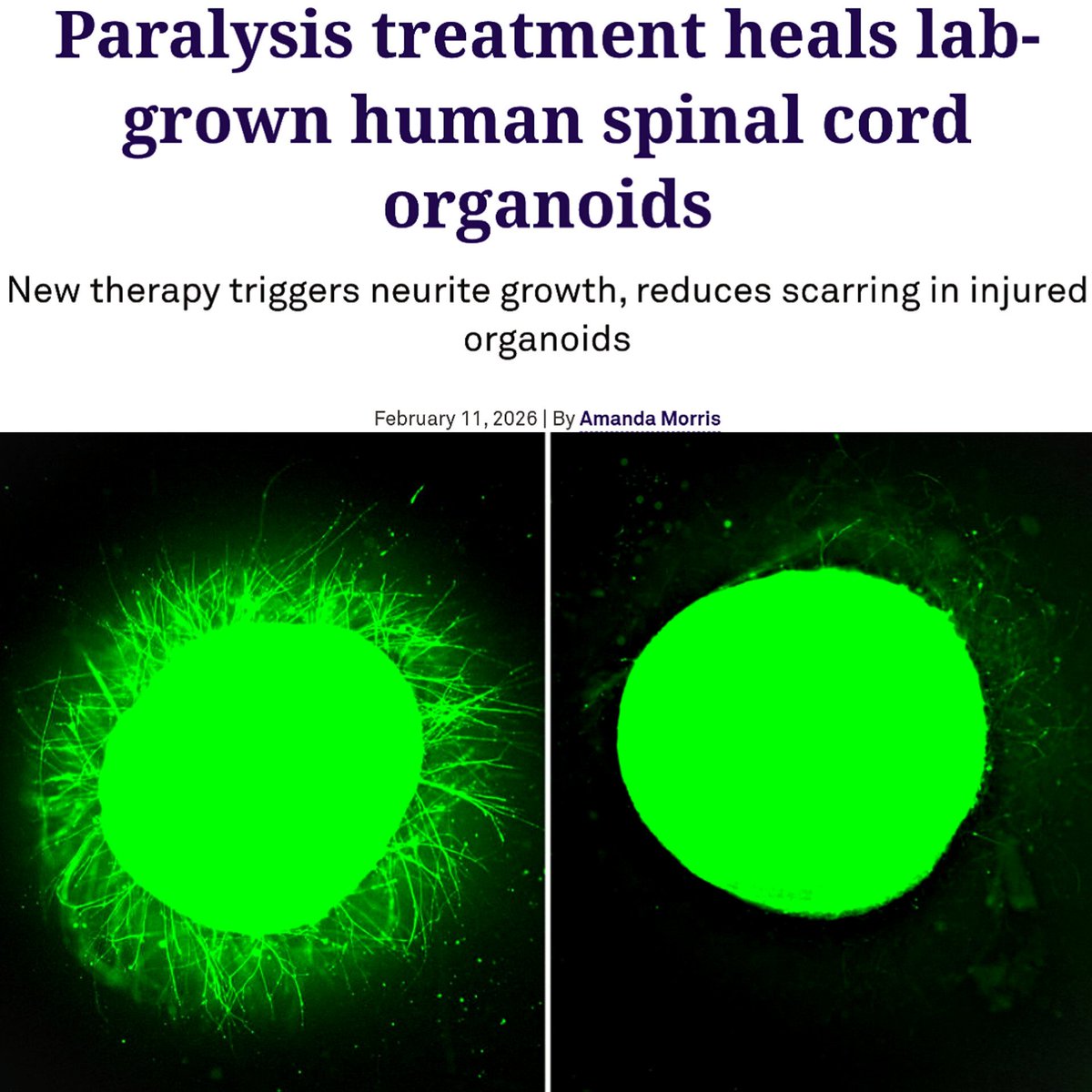BREAKTHROUGH: Scientists just grew mini human spinal cords, then made them repair after injury.

Scientists have shown that a regenerative therapy called “dancing molecules” can repair damage in lab grown human spinal cord organoids.

Researchers created miniature human spinal