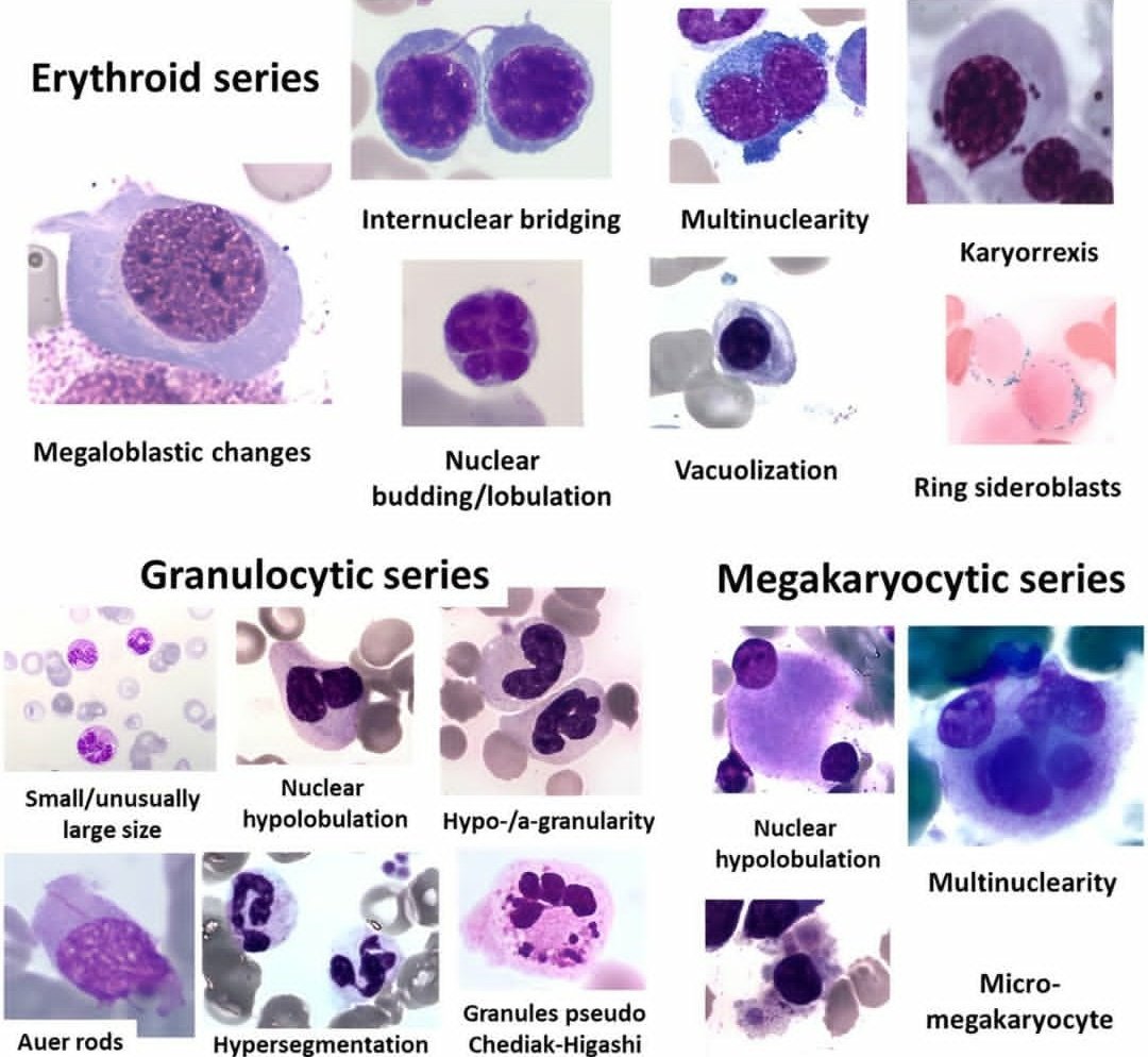 AliAl_khalifah's tweet photo. BONE MARROW DYSPLASIA FEATURES
#granulopoyesis
#DYSPLASIA
#bone #marrow
#dysfunctional
#WBC
#RBc
#RBCiラジオまつり2026 https://t.co/dr6Rxlpn4J