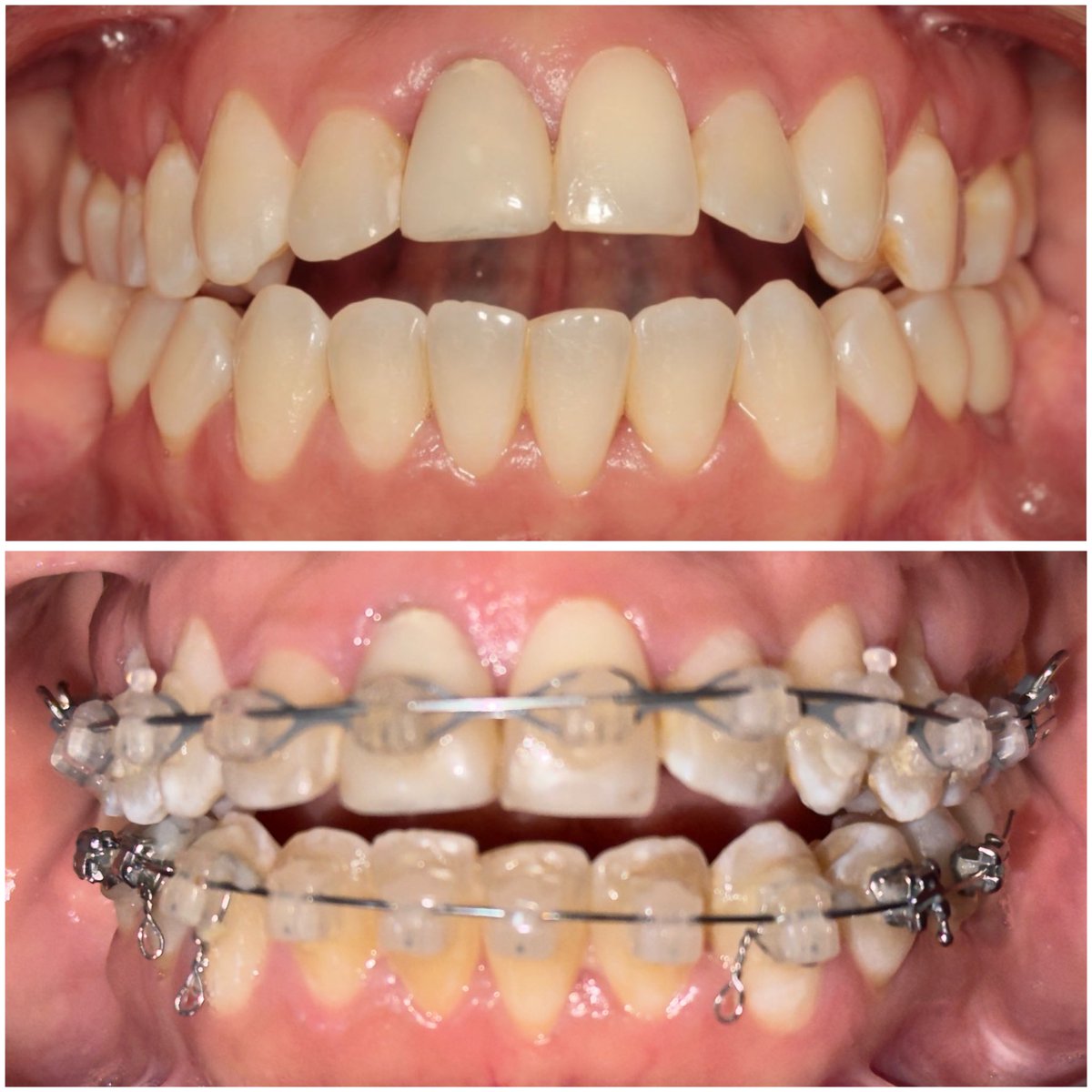 5 meses de tratamiento antes y después… en proceso