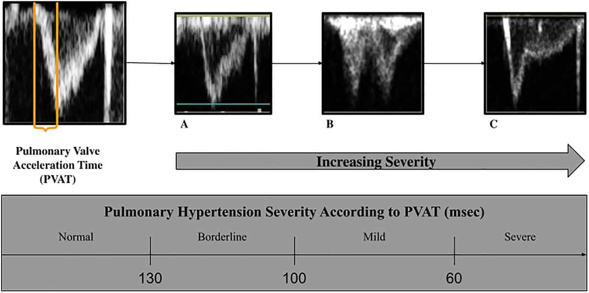 Pulmonary Artery Acceleration Time (PAAT)

■ Pulmonary Artery Acceleration Time (PAAT) is the time interval from the onset of systolic flow to the peak velocity of blood flow in the pulmonary artery, measured using pulsed-wave Doppler.

■ Physiological Meaning

● Reflects