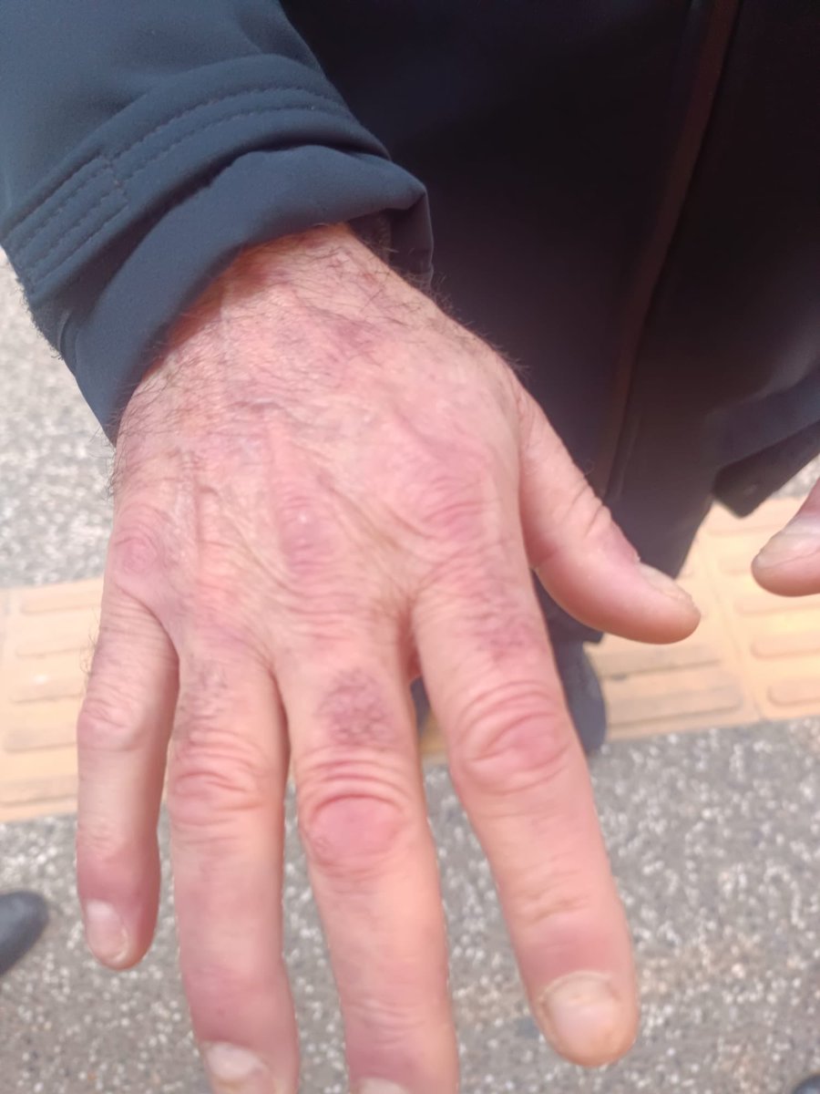 Mesela vitiligo ile hidrojen peroksit doğrudan bağlantılıdr. Yani sadece saçınızı beyazlatmaz aşırı üretimi beyaz deriye neden olur. 

Oksidatif stres çok önemli bir konu cilt ve saç bakımında. Son dönem bu cilt rahatsızlıklarının altında yatan ana neden de sulardaki kireç ve