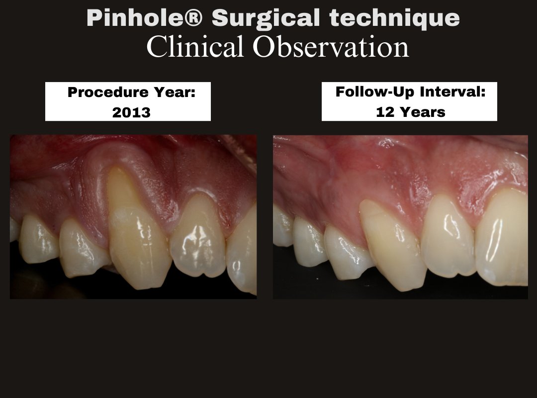 JohnChaodds's tweet photo. Clinical Observation—Gingival Recession
Pinhole® Surgical Technique | Tooth #6
Follow-up: 12 years (2013→2026)
Long-term soft-tissue stability with mature tissue appearance relative to baseline.
#PinholeSurgicalTechnique #ClinicalObservation https://t.co/zrE3pEdFjD